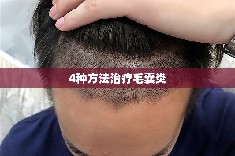 4种方法治疗毛囊炎