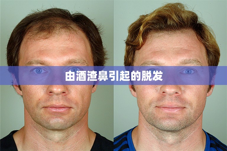 由酒渣鼻引起的脱发 由酒渣鼻引起的脱发