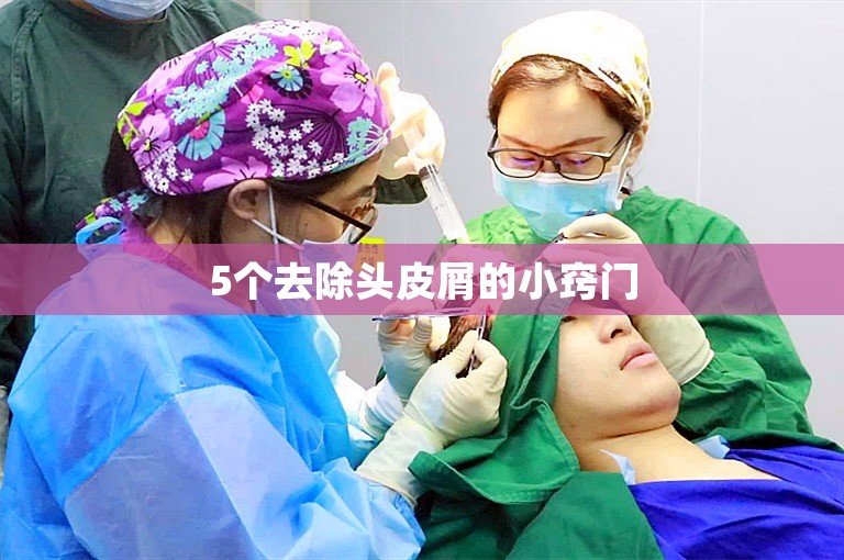 5个去除头皮屑的小窍门