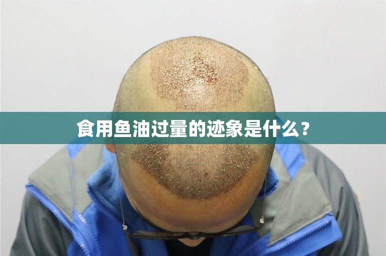 食用鱼油过量的迹象是什么? 食用鱼油过量的迹象是什么?