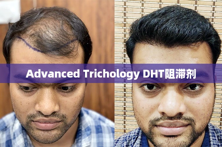 Advanced Trichology DHT阻滞剂 Advanced Trichology DHT阻滞剂