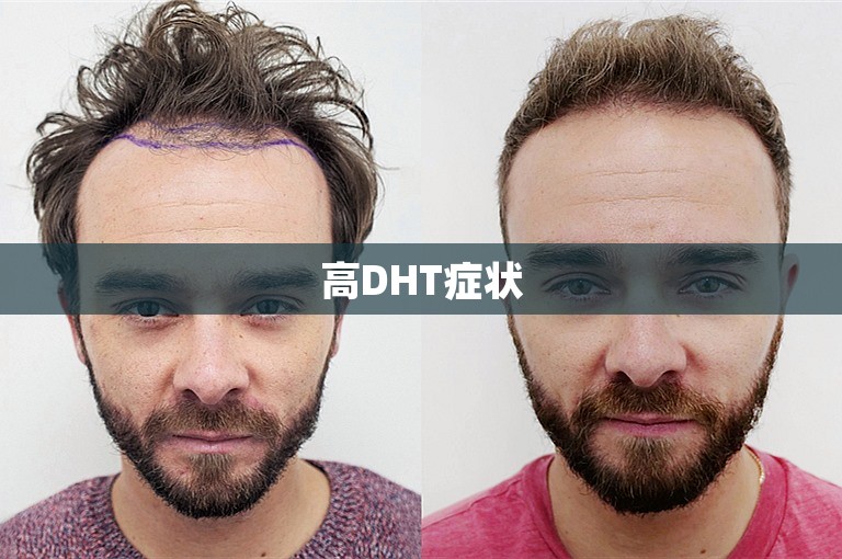 高DHT症状 高DHT症状