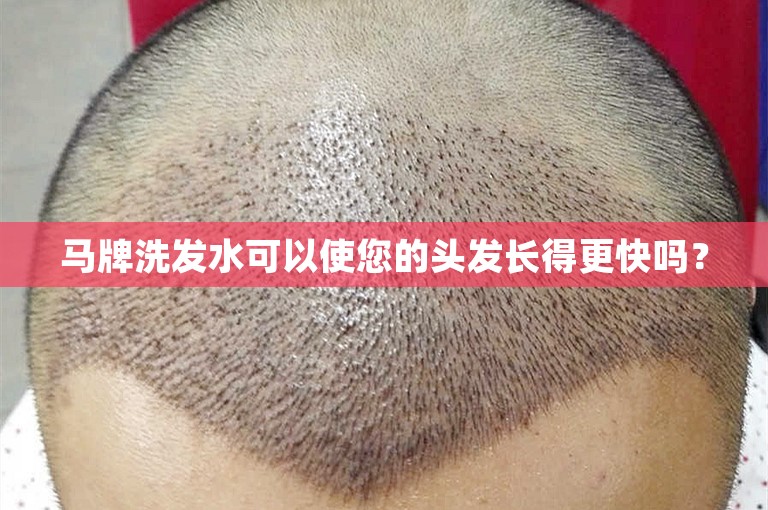 马牌洗发水可以使您的头发长得更快吗? 马牌洗发水可以使您的头发长得更快吗?