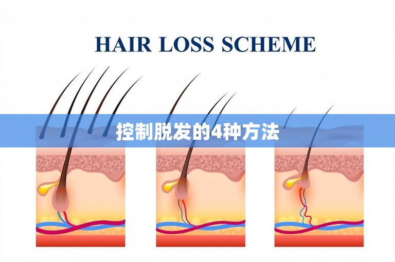 控制脱发的4种方法