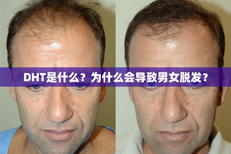 DHT是什么?为什么会导致男女脱发? DHT是什么?为什么会导致男女脱发?