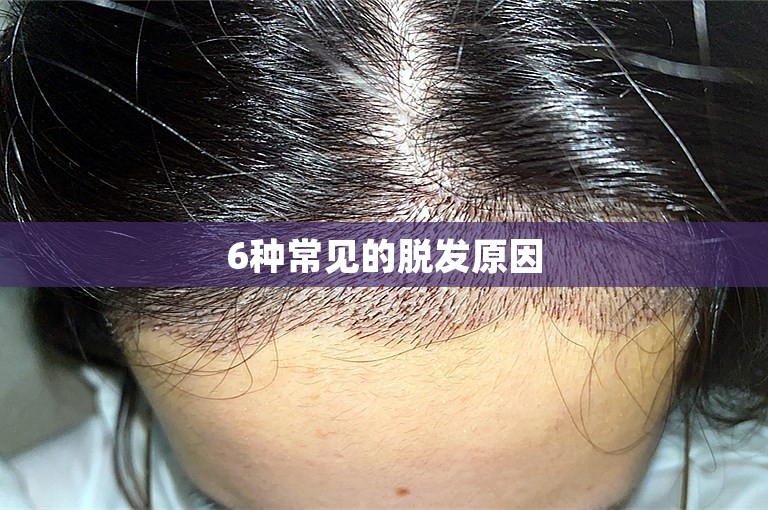 6种常见的脱发原因 6种常见的脱发原因