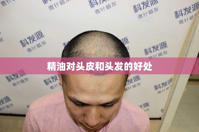 精油对头皮和头发的好处