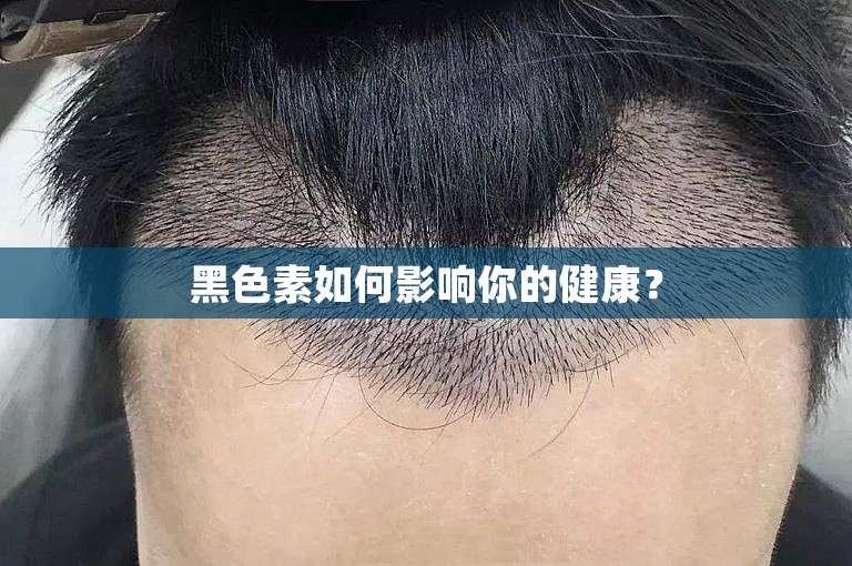 黑色素如何影响你的健康？