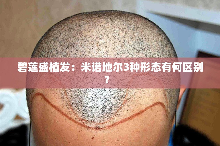 碧莲盛植发：米诺地尔3种形态有何区别？ 