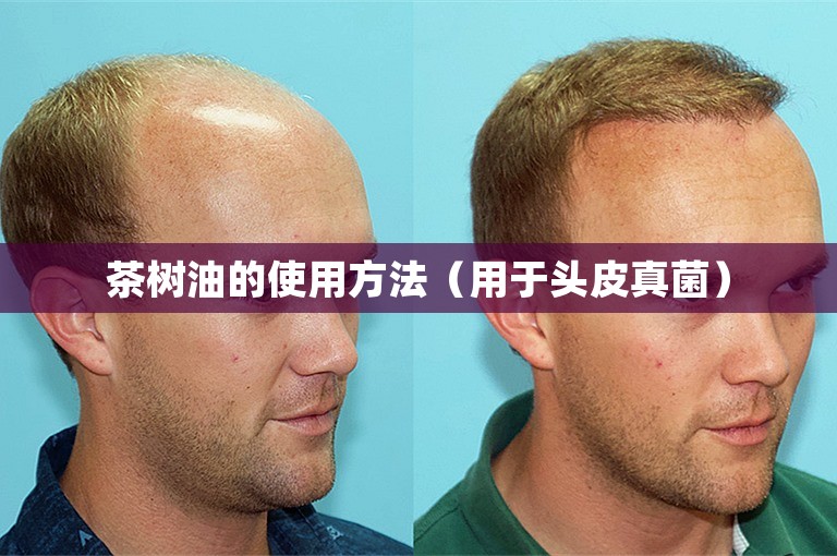 茶树油的使用方法（用于头皮真菌）