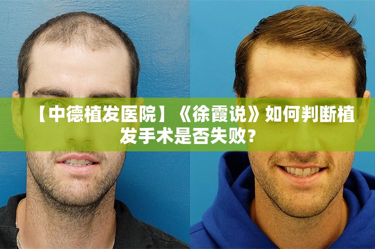 【中德植发医院】《徐霞说》如何判断植发手术是否失败？