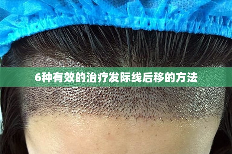 6种有效的治疗发际线后移的方法 6种有效的治疗发际线后移的方法