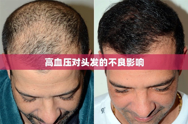高血压对头发的不良影响 高血压对头发的不良影响