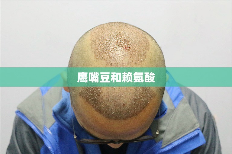 鹰嘴豆和赖氨酸 鹰嘴豆和赖氨酸