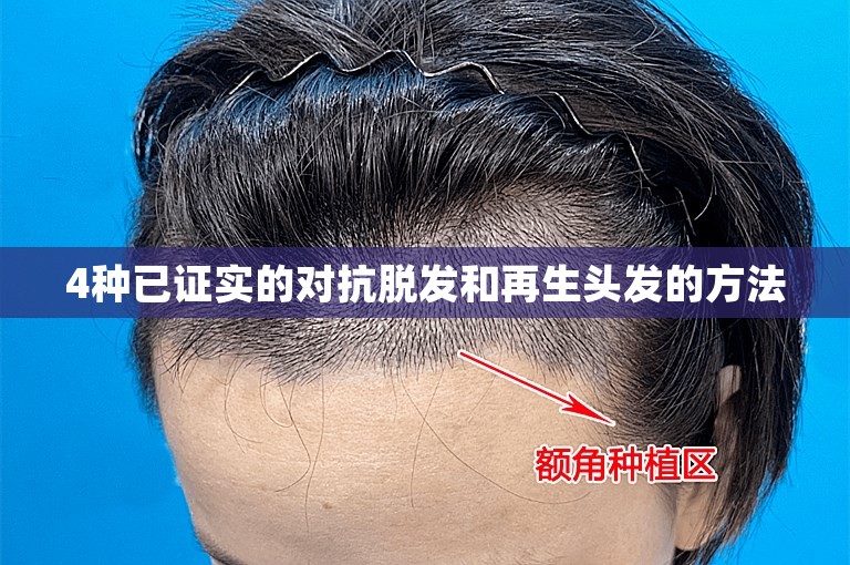 4种已证实的对抗脱发和再生头发的方法
