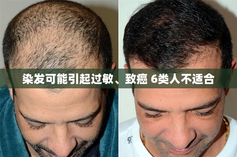 染发可能引起过敏、致癌 6类人不适合