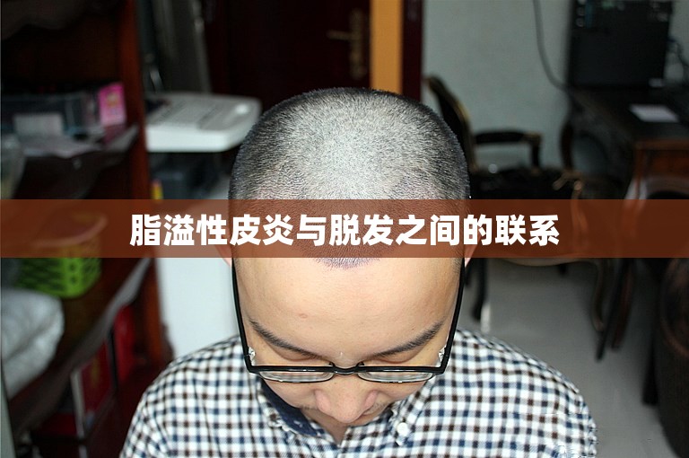 脂溢性皮炎与脱发之间的联系