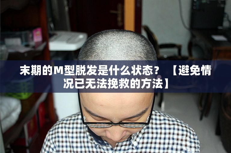 末期的Ｍ型脱发是什么状态？ 【避免情况已无法挽救的方法】