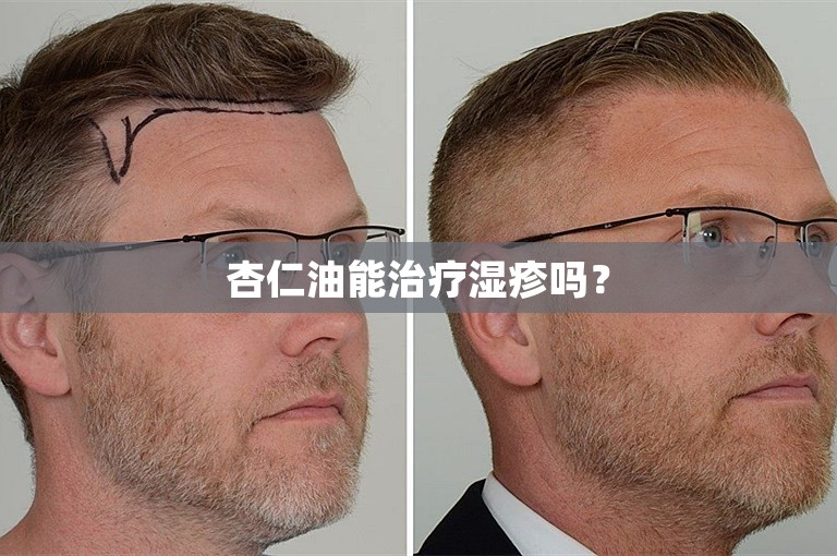 杏仁油能治疗湿疹吗？