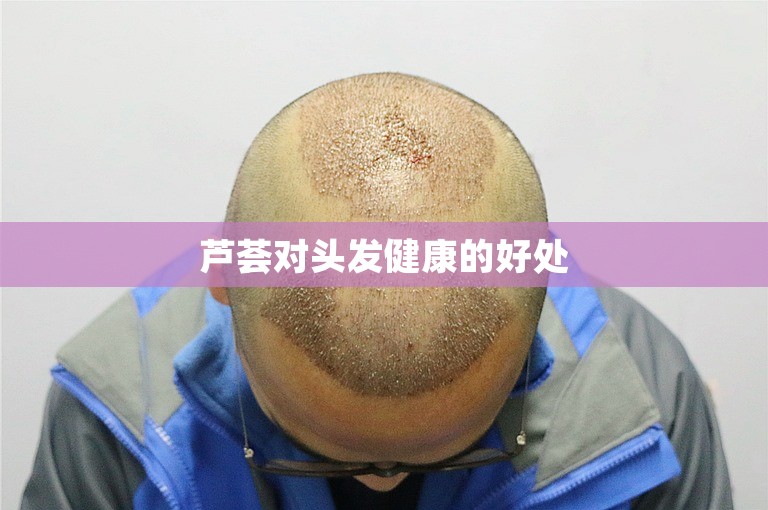 芦荟对头发健康的好处