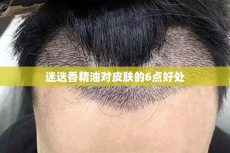 迷迭香精油对皮肤的6点好处