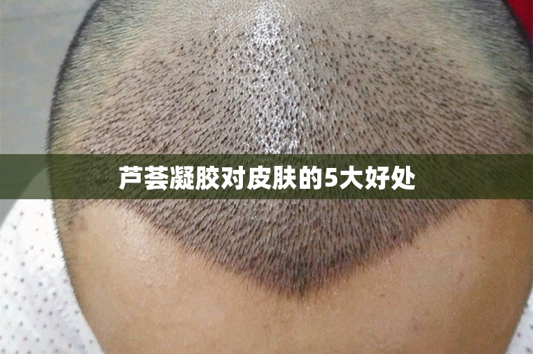 芦荟凝胶对皮肤的5大好处 芦荟凝胶对皮肤的5大好处