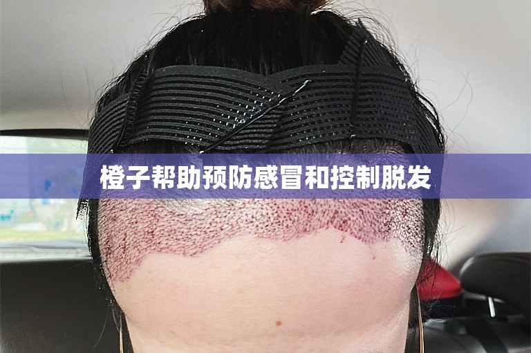橙子帮助预防感冒和控制脱发