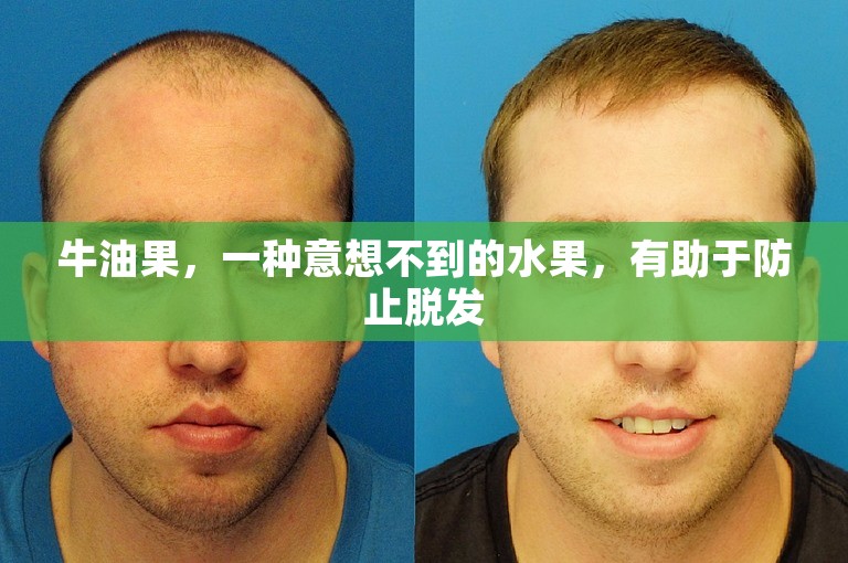 牛油果，一种意想不到的水果，有助于防止脱发