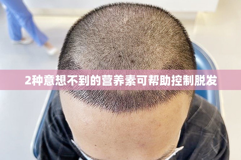 2种意想不到的营养素可帮助控制脱发