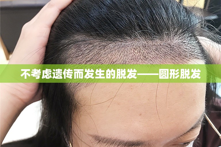 不考虑遗传而发生的脱发——圆形脱发