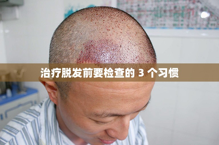 治疗脱发前要检查的 3 个习惯