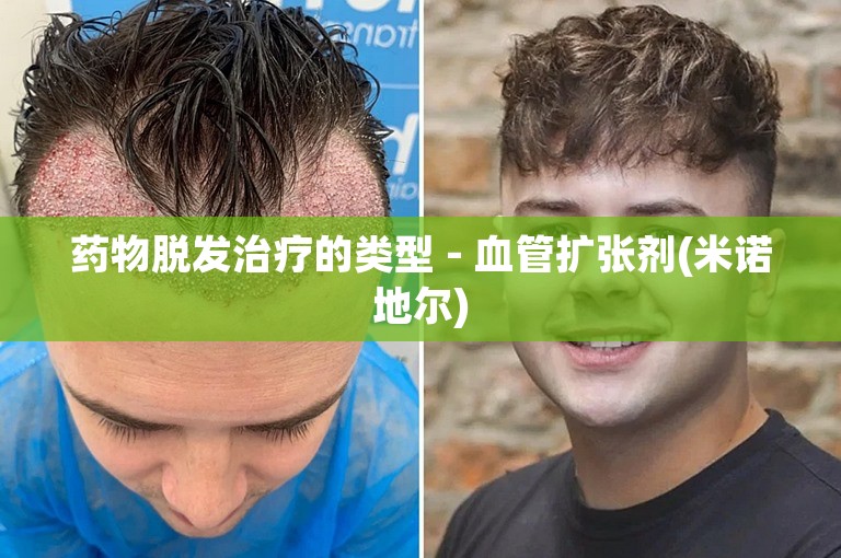 药物脱发治疗的类型 - 血管扩张剂(米诺地尔)
