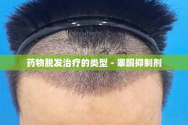药物脱发治疗的类型 - 睾酮抑制剂