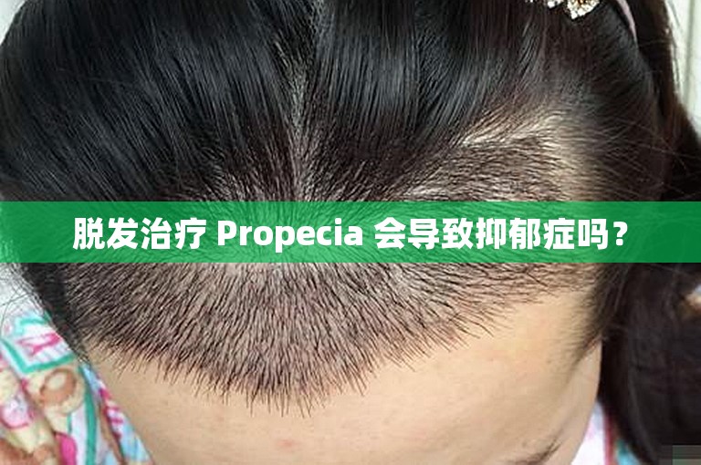 脱发治疗 Propecia 会导致抑郁症吗？
