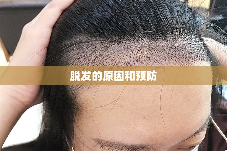 脱发的原因和预防