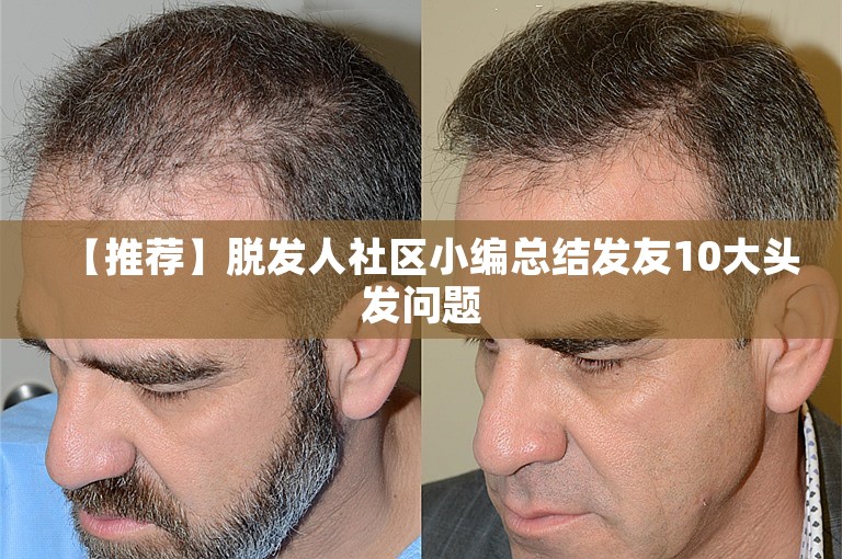 【推荐】脱发人社区小编总结发友10大头发问题 【推荐】脱发人社区小编总结发友10大头发问题