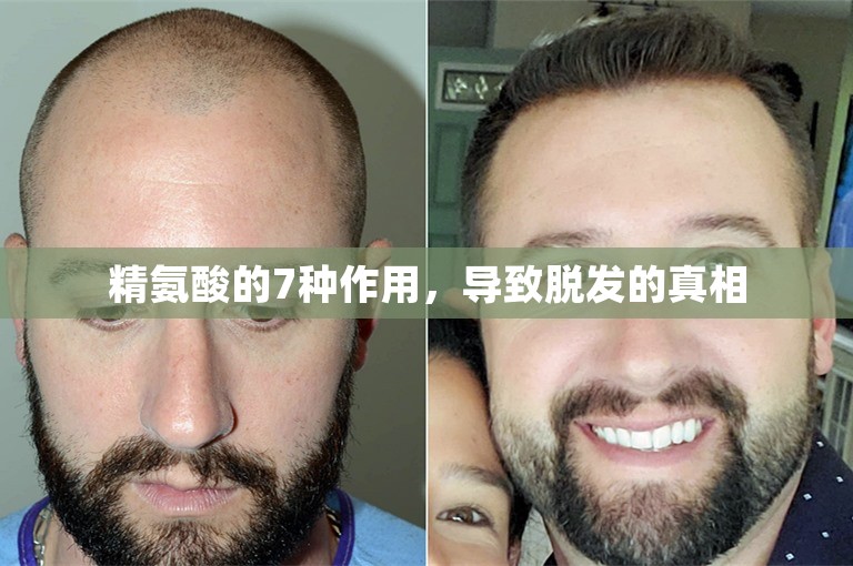 精氨酸的7种作用，导致脱发的真相