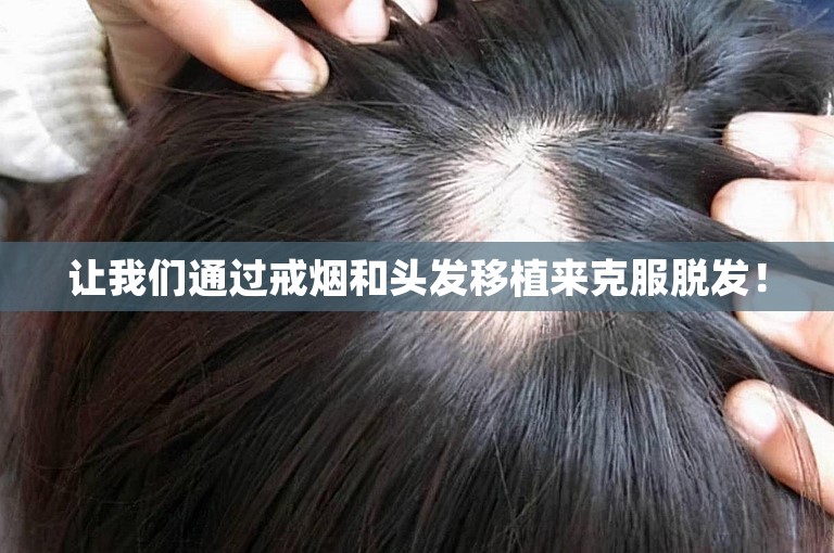 让我们通过戒烟和头发移植来克服脱发! 让我们通过戒烟和头发移植来克服脱发!
