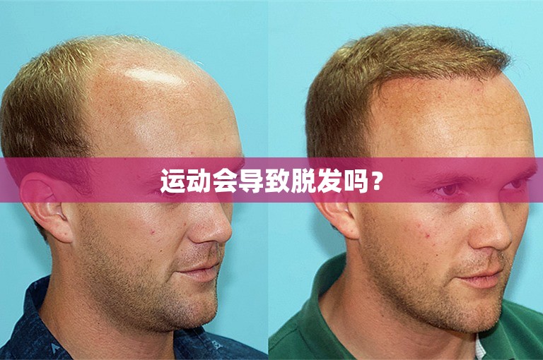 运动会导致脱发吗？