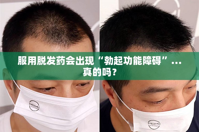 服用脱发药会出现“勃起功能障碍”...真的吗？