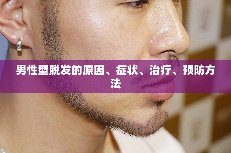 男性型脱发的原因、症状、治疗、预防方法