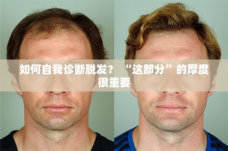 如何自我诊断脱发？ “这部分”的厚度很重要