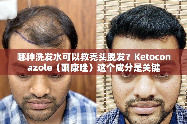 哪种洗发水可以救秃头脱发？Ketoconazole（酮康唑）这个成分是关键