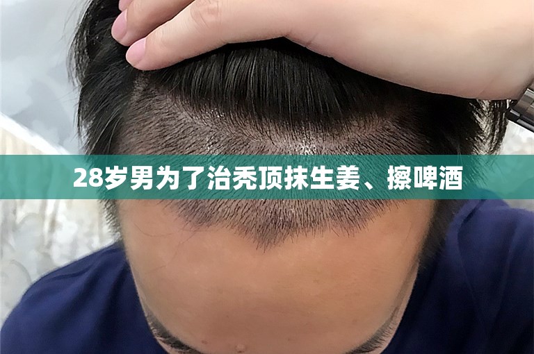 28岁男为了治秃顶抹生姜、擦啤酒