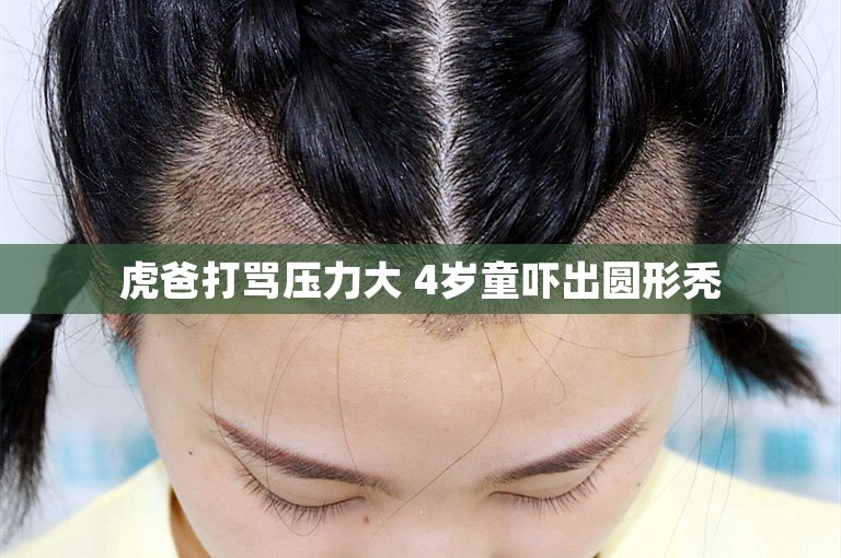 虎爸打骂压力大 4岁童吓出圆形秃