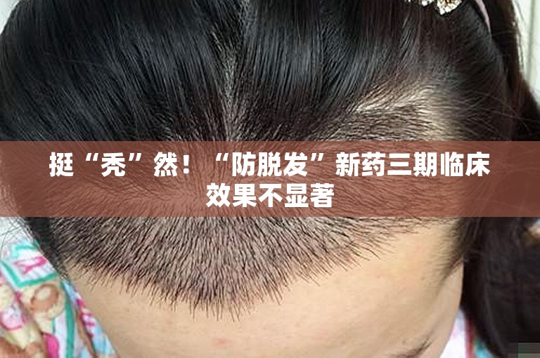 挺“秃”然!“防脱发”新药三期临床效果不显著 挺“秃”然!“防脱发”新药三期临床效果不显著