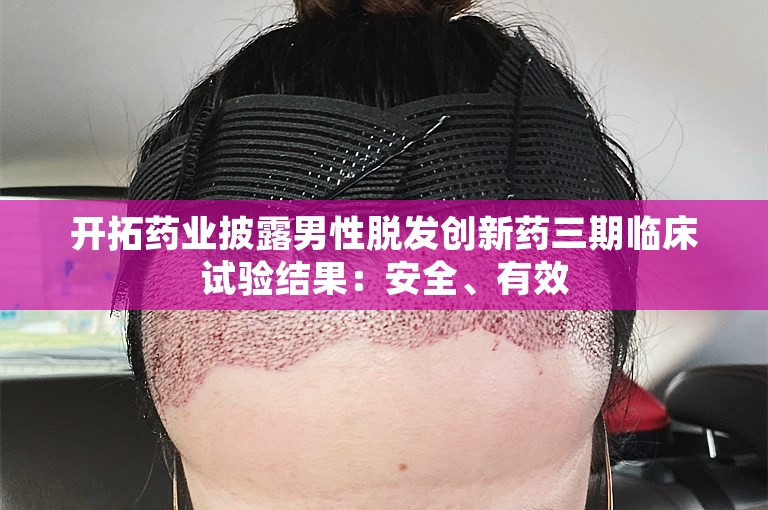 开拓药业披露男性脱发创新药三期临床试验结果：安全、有效