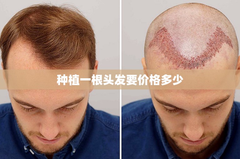 种植一根头发要价格多少
