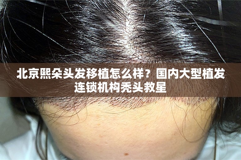 北京熙朵头发移植怎么样？国内大型植发连锁机构秃头救星