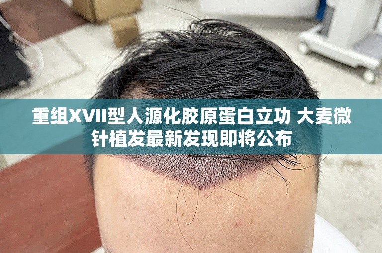重组XVII型人源化胶原蛋白立功 大麦微针植发最新发现即将公布